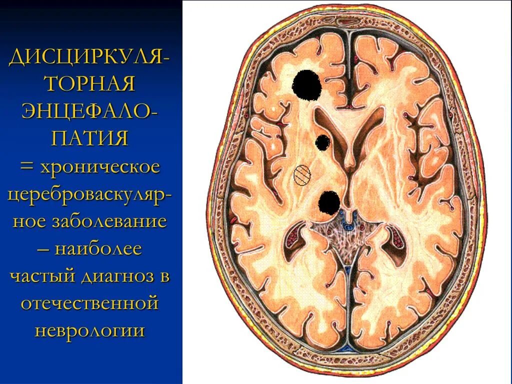 Дисциркуляторная энцефалопатия на кт. Энцефалопатия головного мозга что это такое. Дисциркуляторной энцефалопатии. Острая энцефалопатия головного мозга. Хтэ болезнь