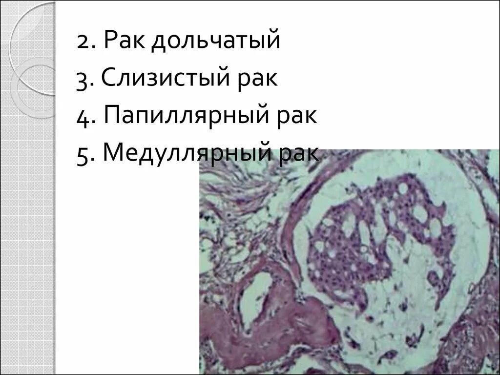 Медулярный рак. Папиллярная карцинома. Папиллярное строение опухоли. Папиллярные выросты на языке.