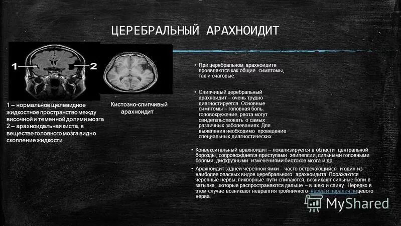 Арахноидальные изменения ликворокистозного характера. Посттравматический кистозный арахноидит. Церебральный кистозный арахноидит. Слипчивый арахноидит мрт.