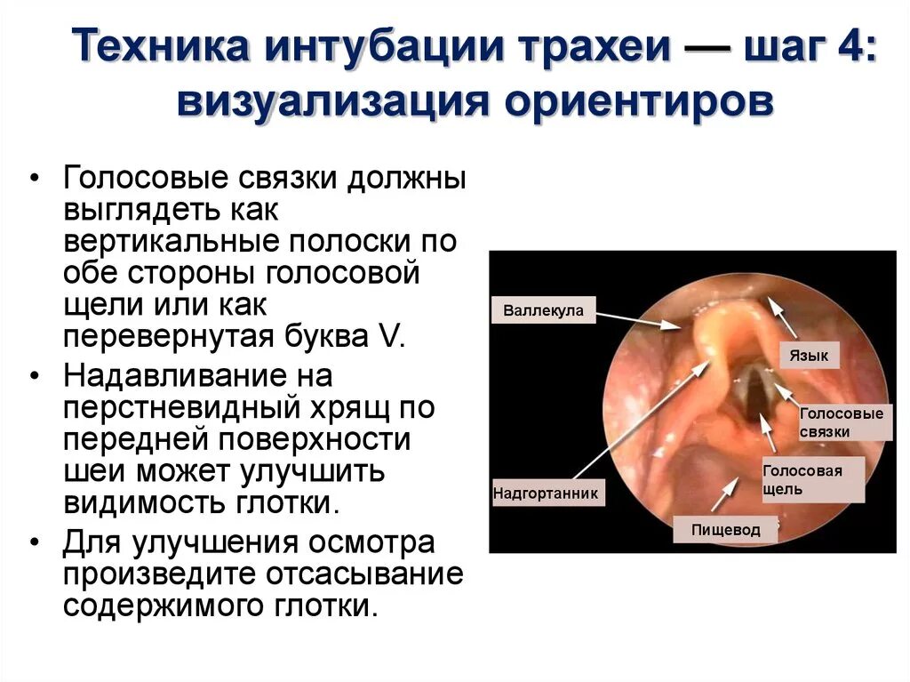 Интубация трахеи без ларингоскопа. Интубация трахеи эндотрахеальной трубкой. Интубация трахеи методика. Голосовая щель при интубации трахеи. Осложнения трахеи