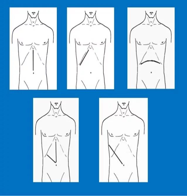 Какое лапаротомия. Лапаротомия брюшной полости. Разрезы при лапаротомии. Верхняя срединная лапаротомия.