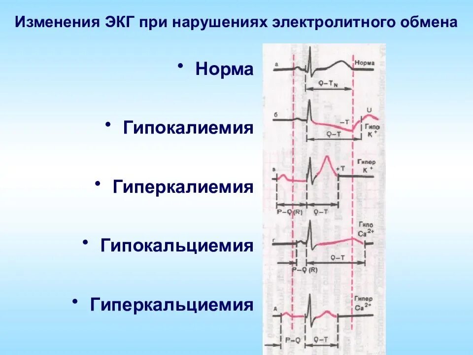 Изменения на ЭКГ при гипокальциемии. Отрицательный зубец р после QRS комплекса. ЭКГ при гипокалиемии и гиперкалиемии. ЭКГ критерии гипокальциемии. Нарушение реполяризации передне перегородочной области