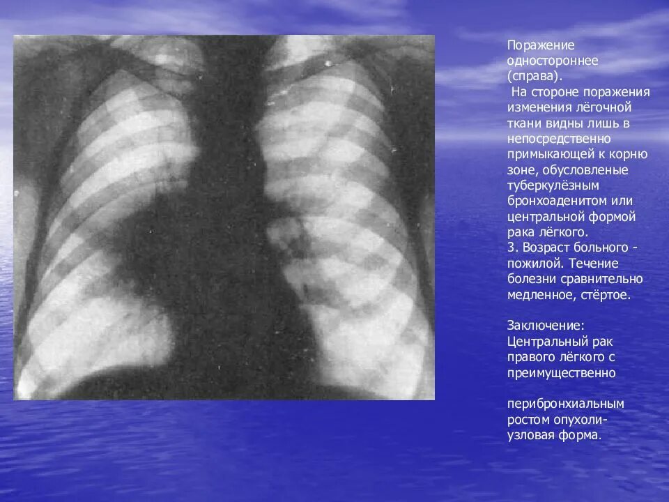 Легкая форма поражения легких. Туберкулёзный бронхоаденит на рентгенограмме. Поражение легочной ткани. 10 Процентов поражения легких.