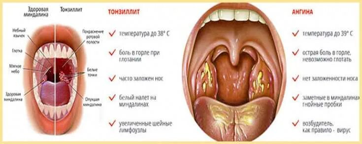 Небные миндалины тонзиллит. Хронический тонзиллит налет. Слюна при боли в горле