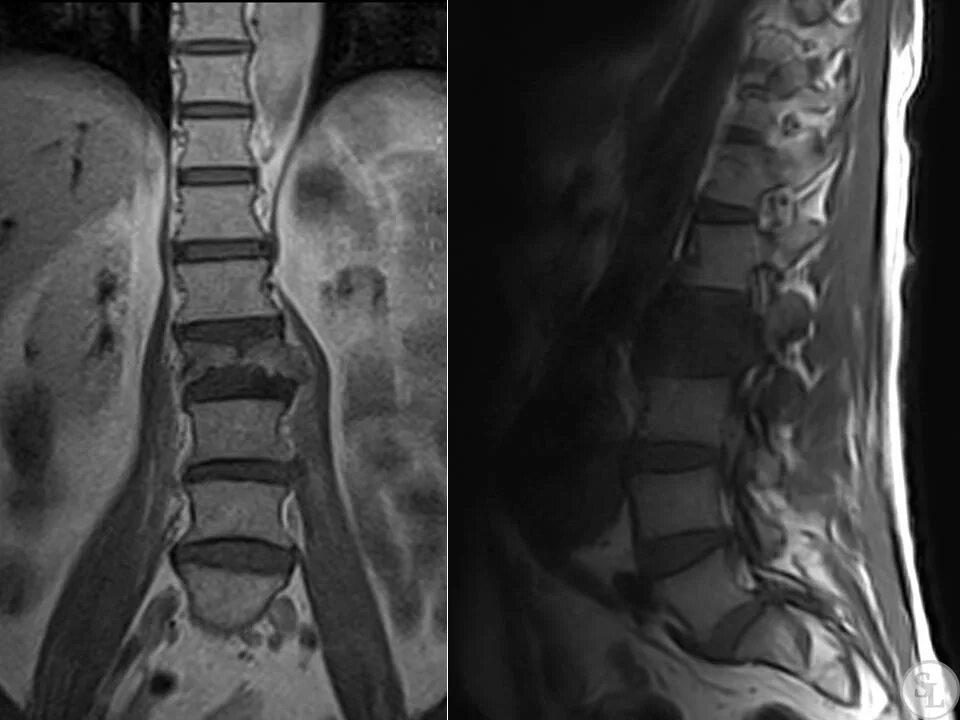 Остеосаркома позвонка рентген. Метастазы в костях позвоночника на кт. Остеосклеротические метастазы в позвоночнике. Метастазы в позвоночнике на мрт. Опухоль в поясничном отделе