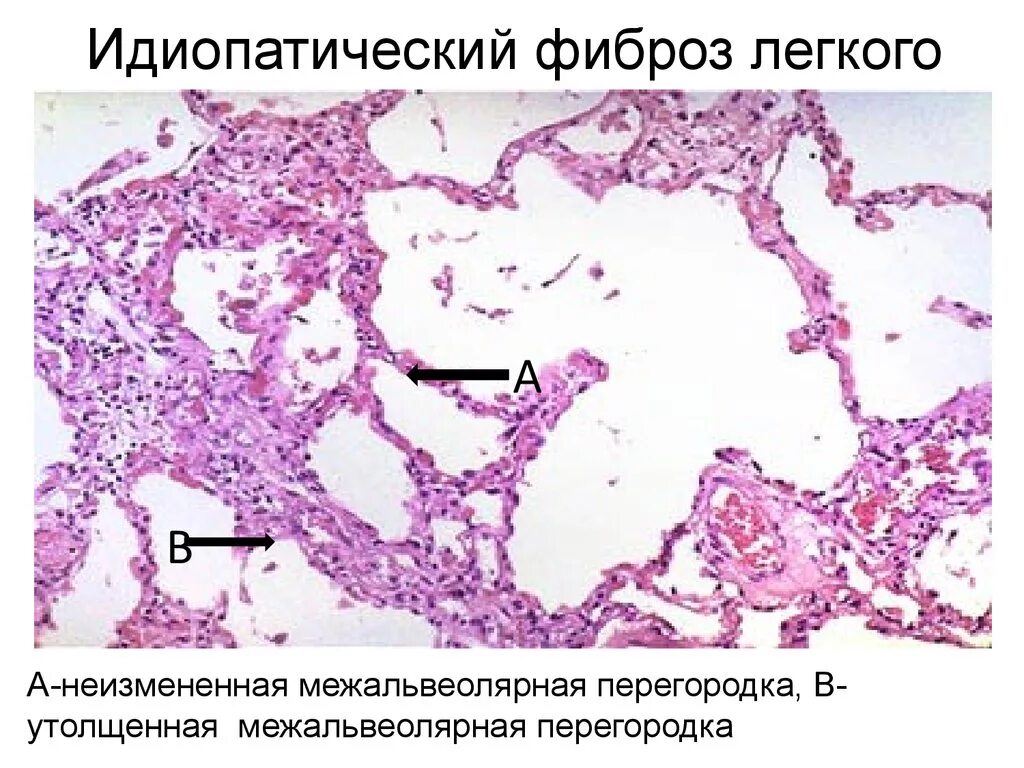 Фиброзно склеротические изменения. Межальвеолярные перегородки гистология. Идиопатический легочный фиброз гистология. Фиброз легкого гистология. Идиопатический фиброзирующий альвеолит.