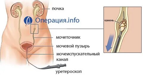Сколько время операция почки