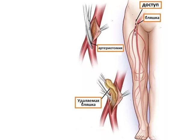 Операция на артерии нижних конечностей