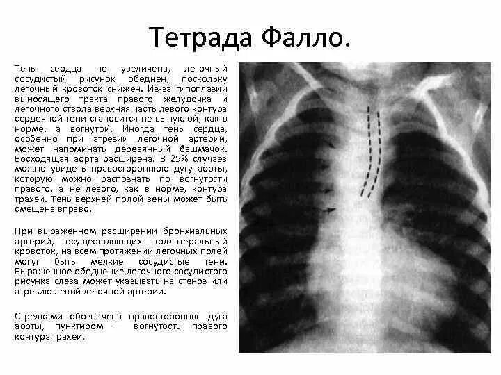 Что значит расширен поперечник сердца