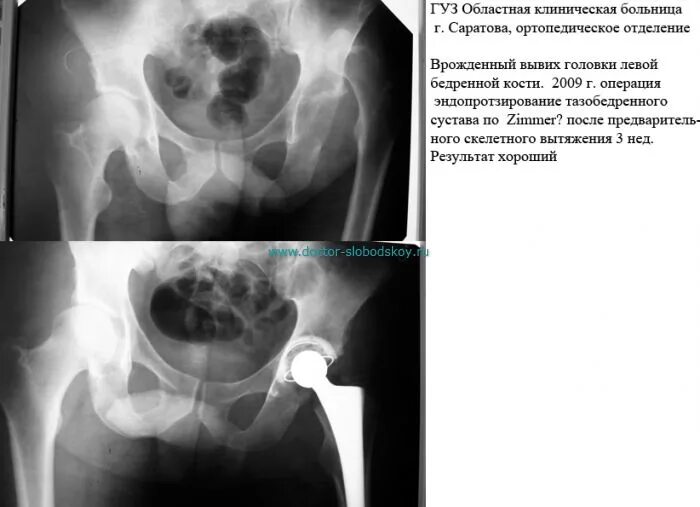Вывих после эндопротезирования тазобедренного. Эндопротез тазобедренного сустава рентген протокол. снимок эндопротеза тазобедренного сустава рентгеновский. подвывих эндопротеза тазобедренного. подвывих эндопротеза тазобедренного сустава рентген.