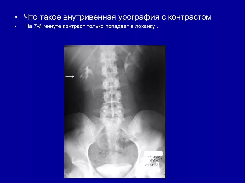Урография с контрастом. Внутривенная урограмма. камни в почках внутривенная урография. внутривенная урография рентген. контраст для внутривенной урографии.