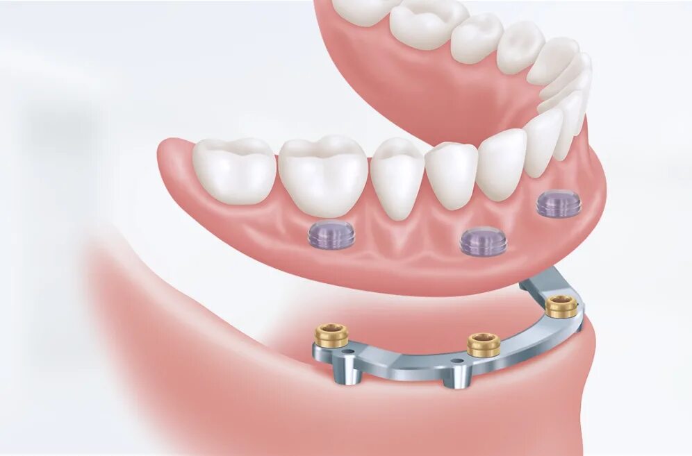 Балка на имплантатах аттачмент mk1. Балочный протез на 6 имплантах. Покрывной протез на имплантах. Балочный протез на имплантах (all on 4).