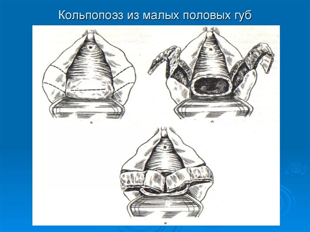 Большие половые губы норма