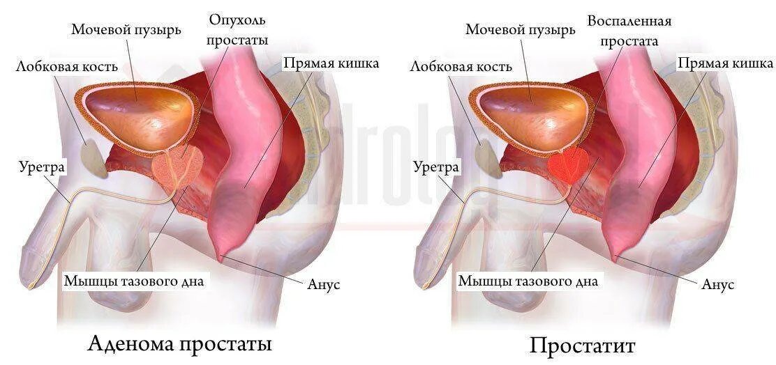 Воспалить простату. Простата нормальная и воспаленная. Простата у мужчин. Простата у мужчин симптомы. Воспаленная аденома простаты.