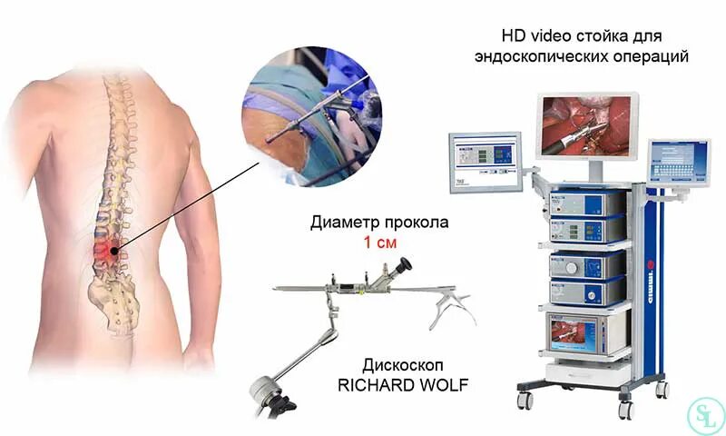 Эндоскопическая дискэктомия грыжи позвоночника. Грыжа позвоночника операция. Эндоскопическая операция на позвоночнике. Малоинвазивные операции на позвоночнике. Позвоночник операция лазером