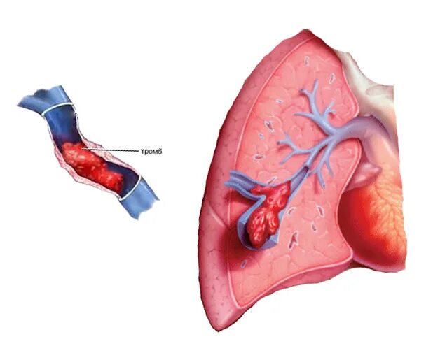 Тромбоэмболия легочной артерии. Массивная тромбоэмболия. Омбоэмболия лёгочной артерии. Тромбофлебит легочной артерии. Сердечный тромбоз