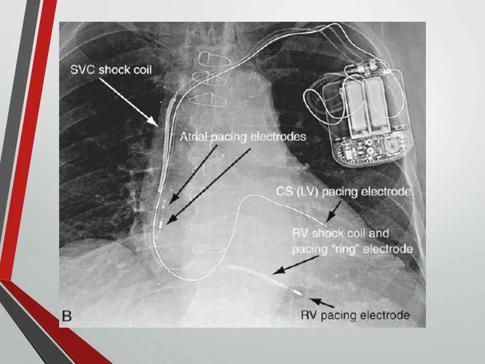 Шок перевод. Имплантируемый кардиовертер-дефибриллятор. Кардиовертер-дефибриллятор на рентгене. Трехкамерный дефибриллятор для сердца.