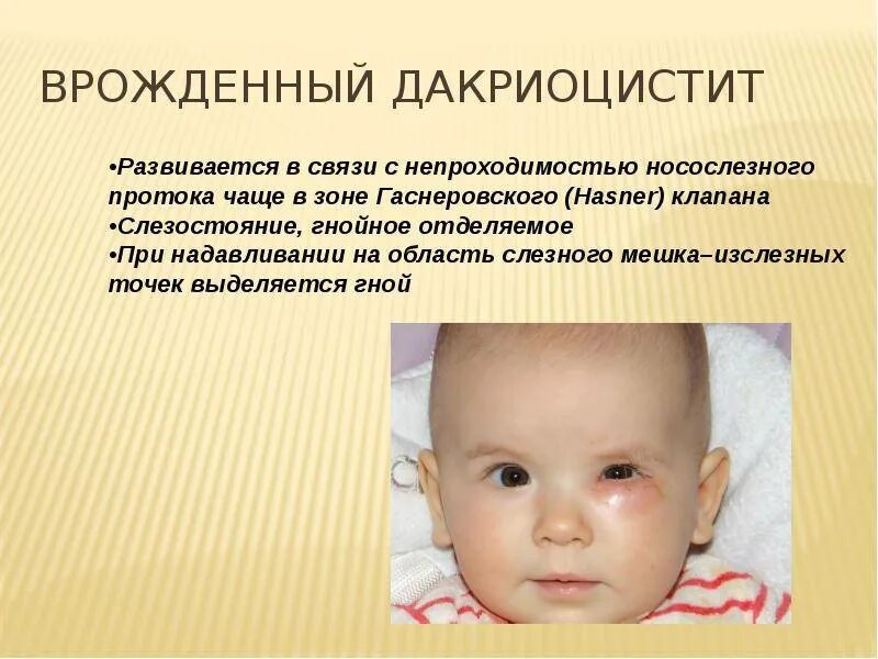 Дакриоцистит как делать массаж. Схема массажа при дакриоцистите у новорожденных. врожденный дакриоцистит. врожденная непроходимость носослезного канала. массаж при дакриоцистите.