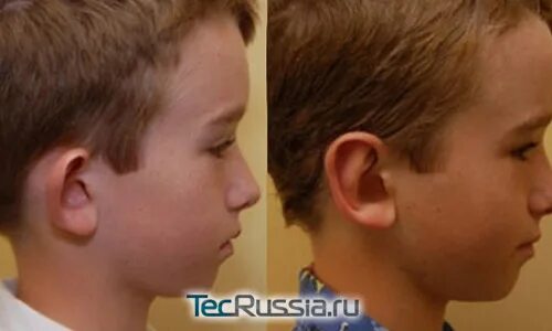 Как сделать чтобы уши не торчали