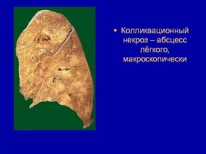 Колликвационный некроз это. Колликвационный (влажный) некроз. макропрепарат влажный колликвационный некроз мозга. колликвационный некроз почки макропрепарат. гангрена легкого макро.
