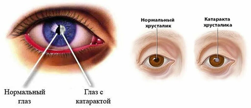Нормальный глаз и катаракта.