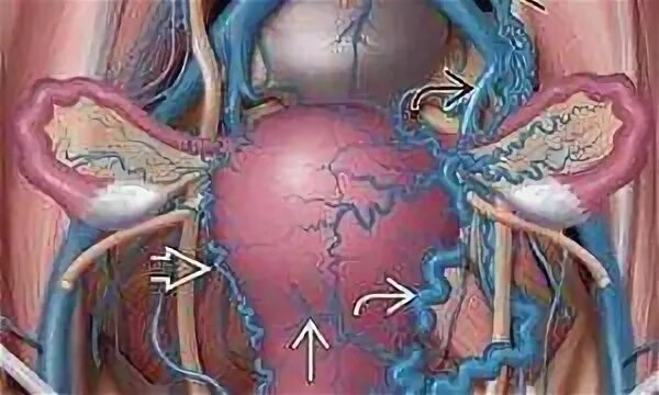 Варикоз органов таза у женщин. Эмболизация вен малого таза. Варикозное расширение вен малого таза у мужчин (ВРВМТ). Тромбоз вен малого таза. Варикозное расширение малого таза симптомы.