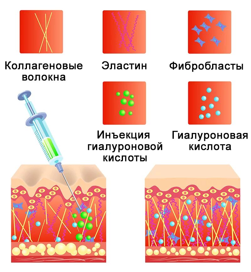 Гиалуроновая кислота средства. Эластин инъекции что это. Механизм действия гиалуроновой кислоты на кожу. Введение коллагена в кожу. Клетки фибробласты в коже.