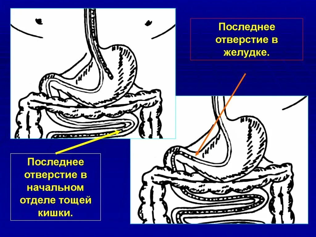 Непроходимость желудка. Свежие дырочки