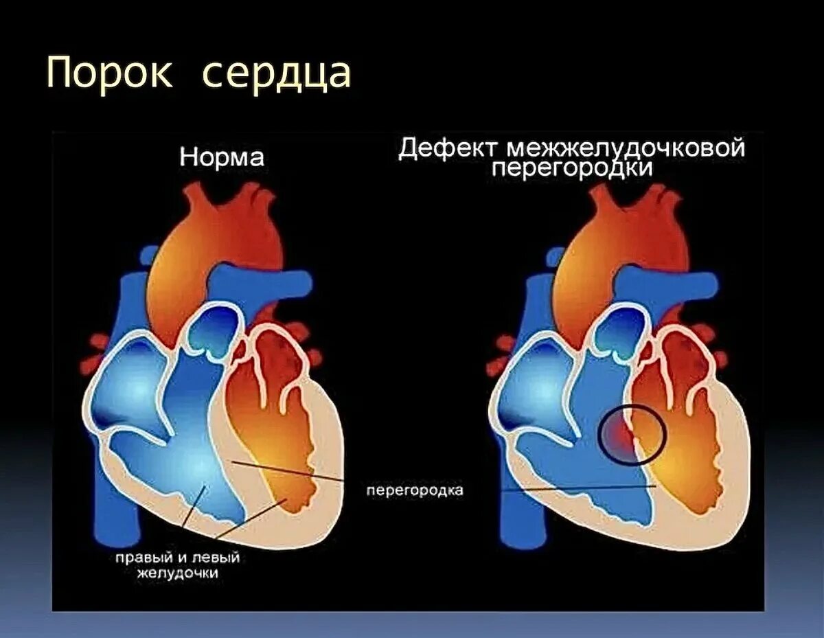 Врожденные и приобретенные пороки сердца. Врожденный порог сердца.