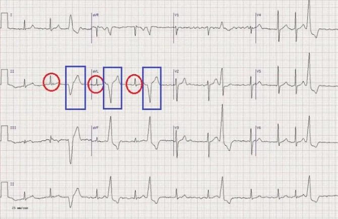 Желудочковая экстрасистолия заключение экг. Интерполированная экстрасистола на экг. Холтеровское мониторирование синусовая аритмия. Желудочковая парасистолия на экг. Суправентрикулярная экстрасистолаэкг.