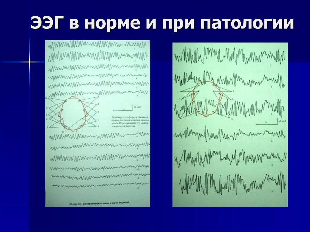 Ээг часовой. Расшифровка показателей электроэнцефалограммы ээг головного мозга. ритмы на ээг у детей норма. ээг нормальные показатели у ребенка. электрод f5 ээг.