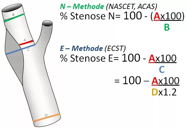 Ecst стеноз. Стеноз по nascet. Стеноз nascet. Ecst стеноз. Ecst стеноз.