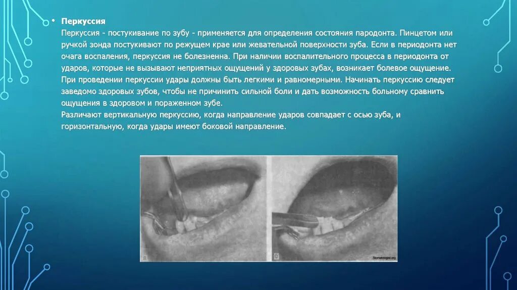 Перкуссия зуба. Перкуссия зуба. Перкуссия зуба. Перкуссией зуба оценивается состояние:. Горизонтальная перкуссия зуба.