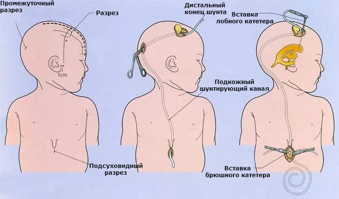 Внутричерепное давление у ребенка 7 лет. Гидроцефалия головного шунт. шунт гидроцефалии схема. гидроцефалия головного мозга у ребенка шунт. шунтирование гидроцефалии головного мозга у новорожденного.