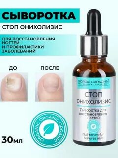 Средство для лечения онихолизиса ногтей