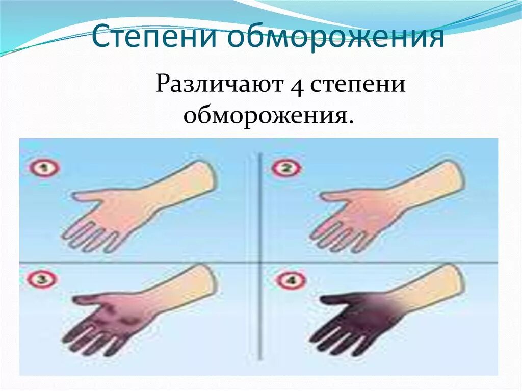 Отморожение 1 степени помощь. Степени обморожения и первая помощь.