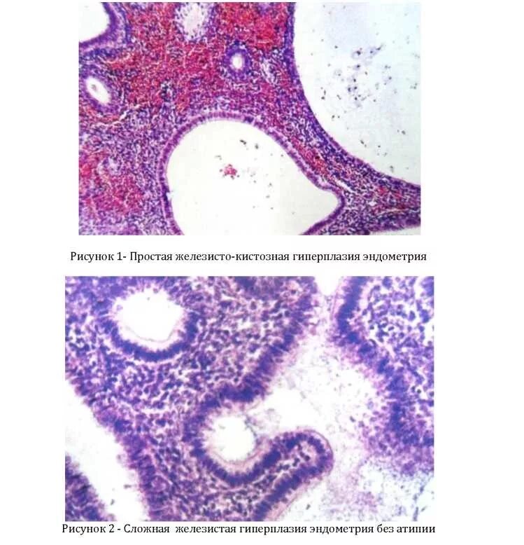 Железистая гиперплазия гистология. Атипическая гиперплазия гистология. Железистая гиперплазия эндометрия гистология классификация. Атипическая гиперплазия эндометрия гистология. Простая железистая гиперплазия эндометрия