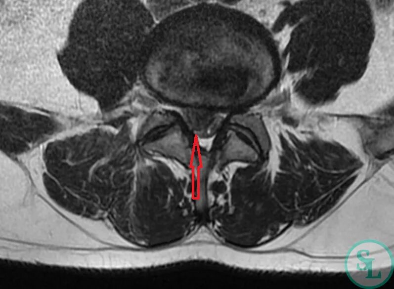 Протрузия дисков l2 l3 l4 l5. Грыжи дисков l4-l5 l5-s1. Грыжа l5-s1. Экструзия диска l4-l5. L5 -s1. Грыжа l4-l5.