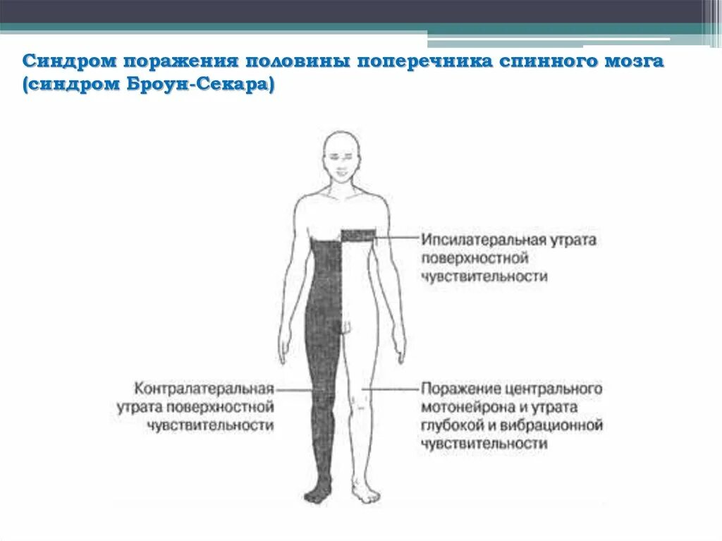 Поражение половины мозга. Синдром поражения половины поперечника спинного мозга. Поражения половины поперечника спинного мозга (синдром Броун-Секара). Синдром поражения половины поперечника спинного мозга диагностика. Синдром при поражении половины поперечника спинного мозга.