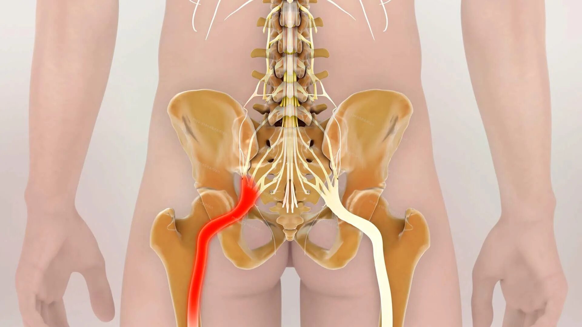 Корешковое защемление в пояснице. Ишиас воспаление седалищного. Ишиас - защемление седалищного нерва. Седалищный нерв анатомия.