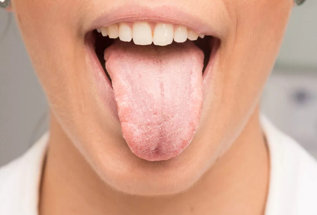Язык признак какой болезни. Бактериальный глоссит. Десквамативный глоссит языка.