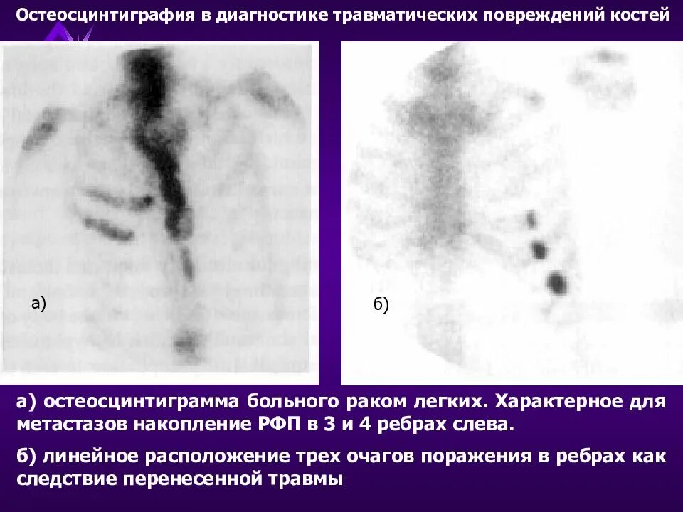 Метастазы при раке болят