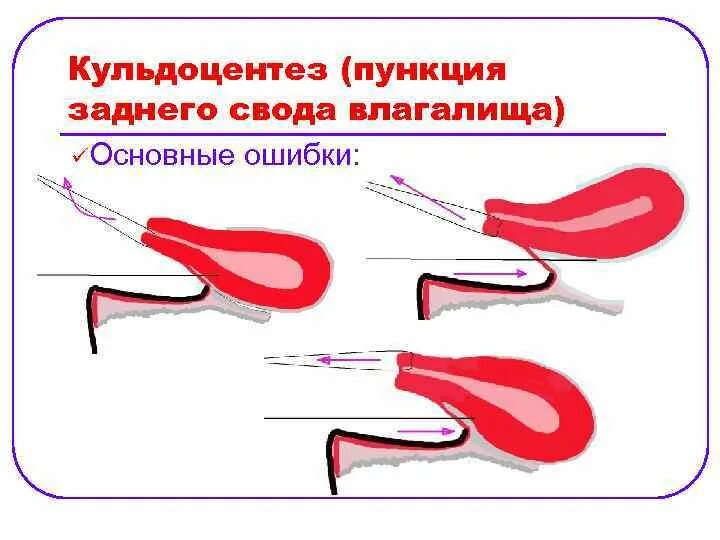 Инструменты для пункции заднего свода влагалища. Пункция заднего свода в гинекологии. Пункция заднего свода влагалища показания. Пункция заднего свода влагалища техника. Задний свод матки