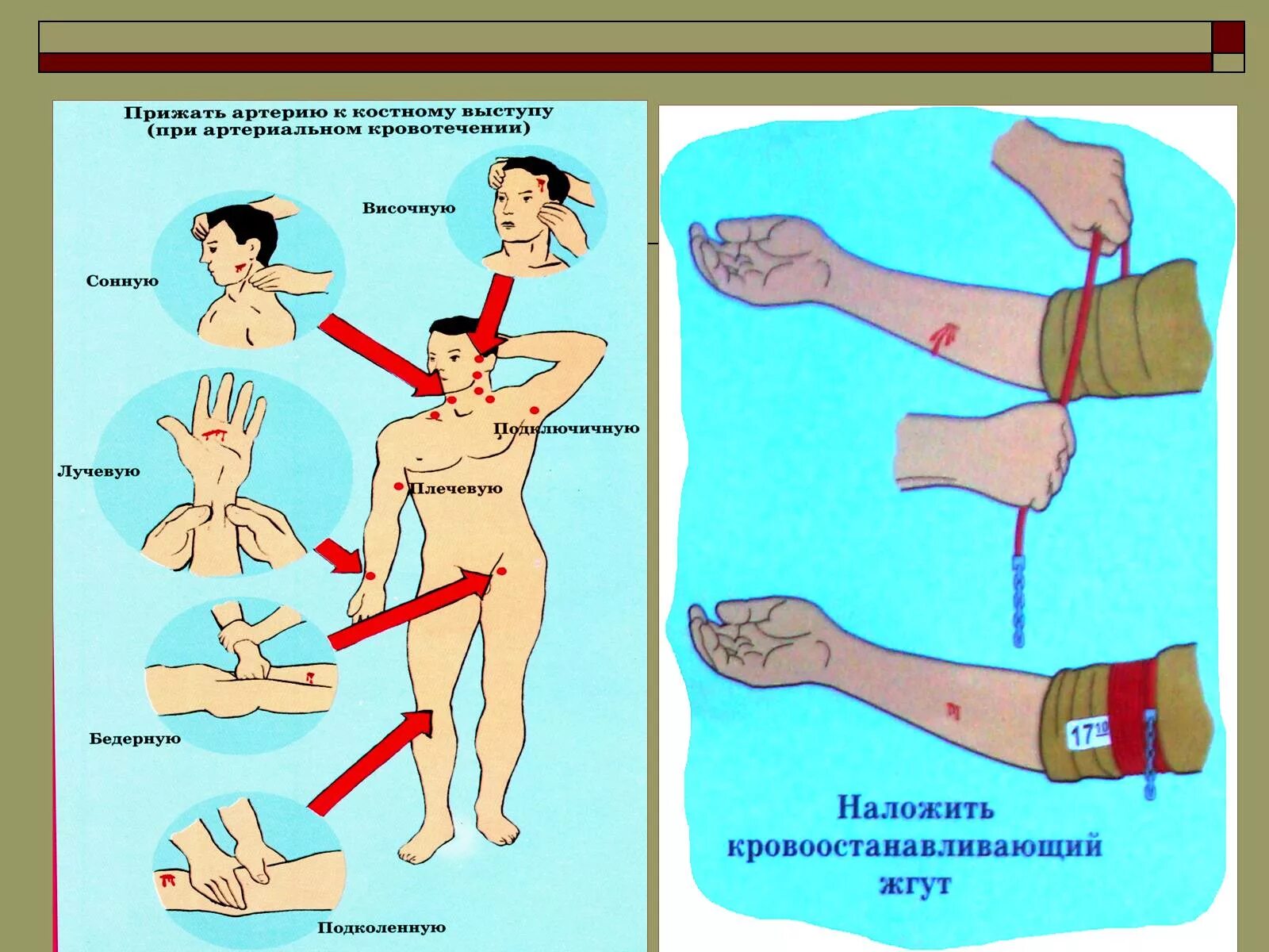 Какой способ артериального кровотечения наиболее эффективен. Артериальное кровотечение. Жгут для остановки артериального кровотечения. Способы артериального кровотечения. Артериальное кровотечение профилактика.