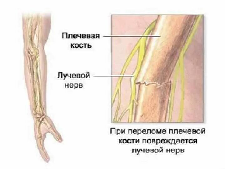 Повреждение лучевого нерва при переломе. Повреждение лучевого нерва при переломе лучевой кости. Повреждения лучевого нерва при переломе плеча. Повреждение лучевого нерва при переломе плечевой кости.