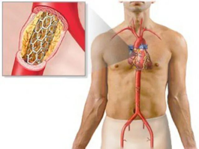 Инфаркт коронарное стентирование. Инфаркт миокарда стент. Операция стентирование сосудов сердца. Стентирование при инфаркте миокарда. Операция при инфаркте миокарда стентирование.