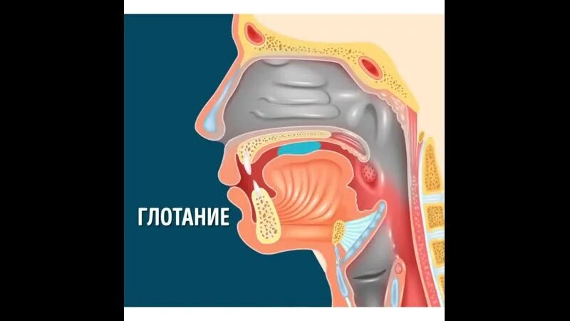 Застряла в трахее
