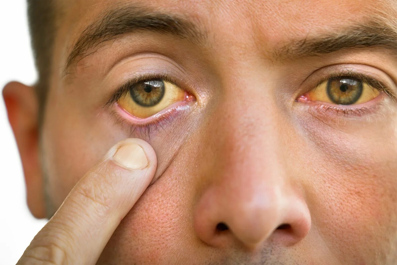 Пожелтение склер гепатит. Жёлтые глаза у человека.