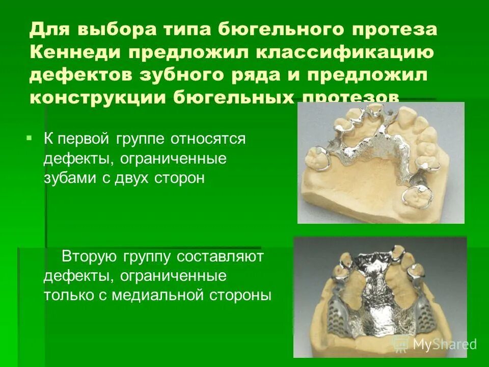 Преимущества и недостатки бюгельных протезов. Преимущества и недостатки бюгельных протезов