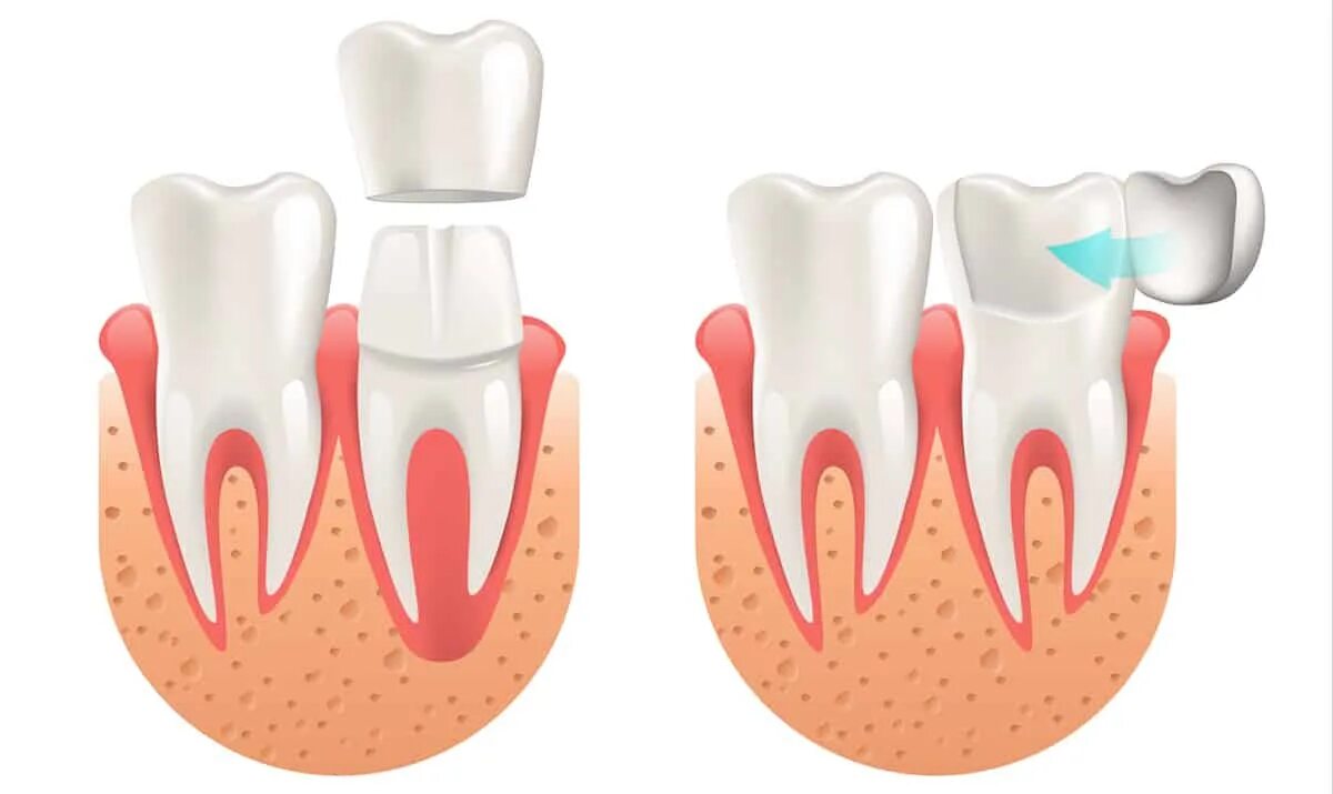 Зубы из диоксида циркония а2. Диоксид циркония цвет блич 1. Отличие коронок. Металлокерамика коронки десна. Отличие коронок.